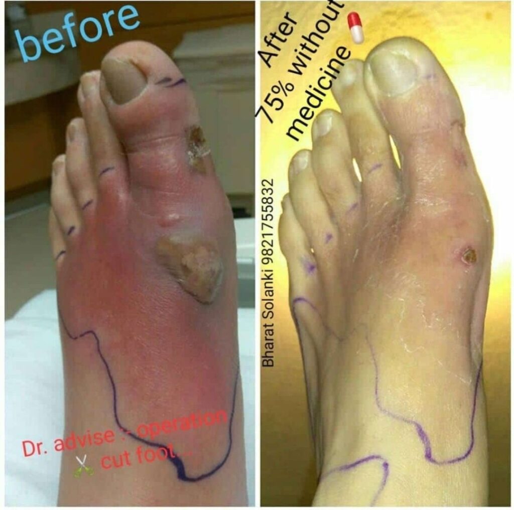 🦶 डायबिटिक फ़ुट – चमत्कारी सुधार बिना दवा और ऑपरेशन के!